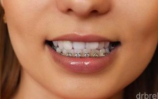 Брекеты на нижнюю челюсть: какие лучше поставить?