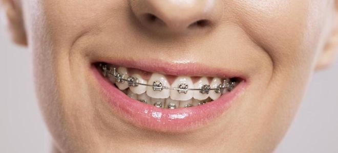 Брекеты Sia Orthodontic