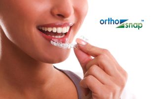 Особенности элайнеров Ortho Snap