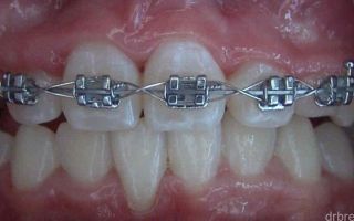 Брекеты на верхнюю челюсть: выбираем лучший вариант
