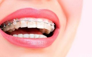 Эстетичные брекеты: какие лучше?