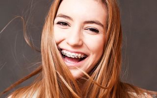 Брекеты American Orthodontics