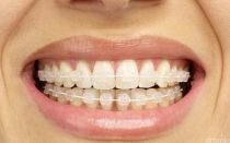 Брекеты Ortho Technology
