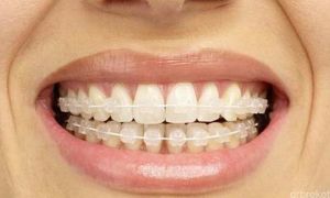 Брекеты Ortho Technology