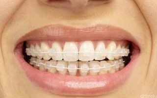 Брекеты Ortho Technology