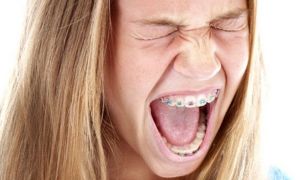 Болят зубы при ношении брекетов: что считается нормой и когда обращаться к врачу