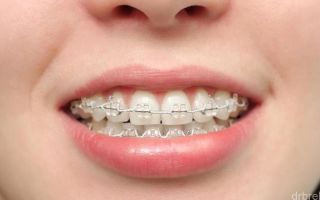 Брекеты Diamante