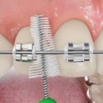 очистить брекеты ёршиком